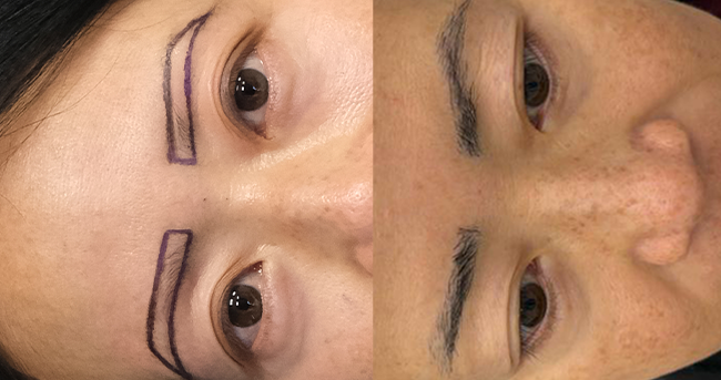 Eyebrow transplant